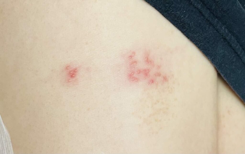 대상포진 증상 2가지와 치료 골든타임 | 어느 병원 가야할까?